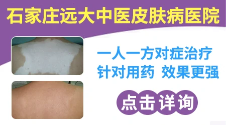 肛周白癜风抹哪种药