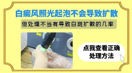 308激光照白斑处起水泡了还有效吗