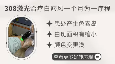 白癜风照308激光治疗要几个月