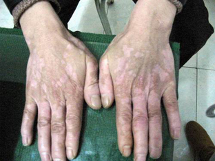 节段型白癜风的症状是什么