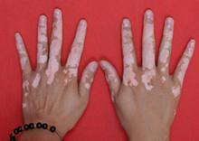  双手白癜风的发病原因和治疗
