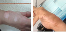 手指上的白癜风能用激光治疗吗