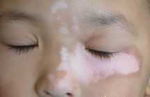 小孩脸上有白斑是什么原因?