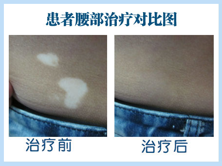 早期白癜风如何治疗效果比较好