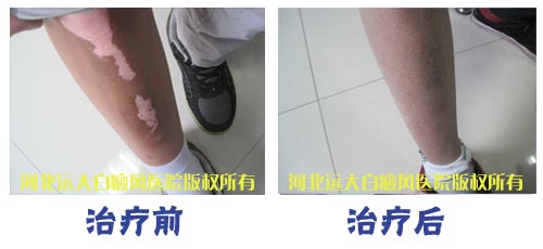 比较小的白癜风不治会不会自动消失