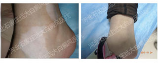 白癜风有什么快速的治疗方法