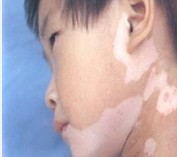 儿童脸部肤色不均匀有白斑是白癜风吗