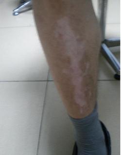 大腿有很多小白斑照UVB能好吗