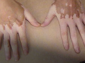 手指和手背白癜风有什么好的治疗方法