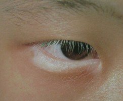 眼睛摩擦导致白癜风能治好吗