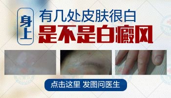 儿童腿部白斑是不是白癜风图片