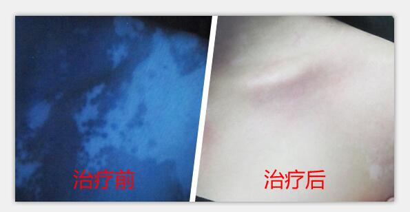 烦恼的白癜风终于在远大帮助下消失了
