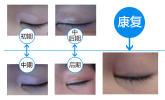 白癜风