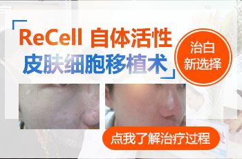 什么叫recell白癜风自体黑色素细胞移植