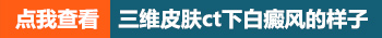 伍德灯下白癜风不太明显了还用照激光吗