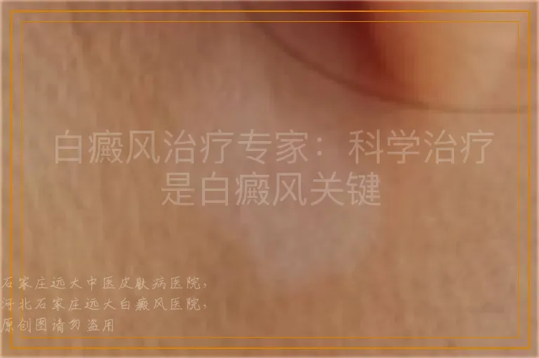 白癜风治疗专家：科学治疗是白癜风关键