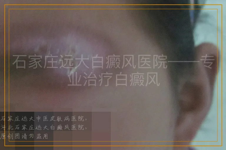 石家庄远大白癜风医院——专业治疗白癜风