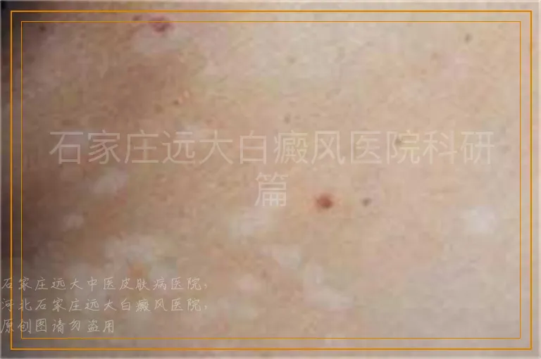 石家庄远大白癜风医院科研篇