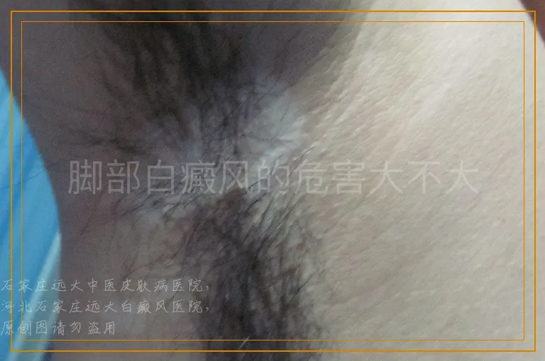 脚部白癜风的危害大不大