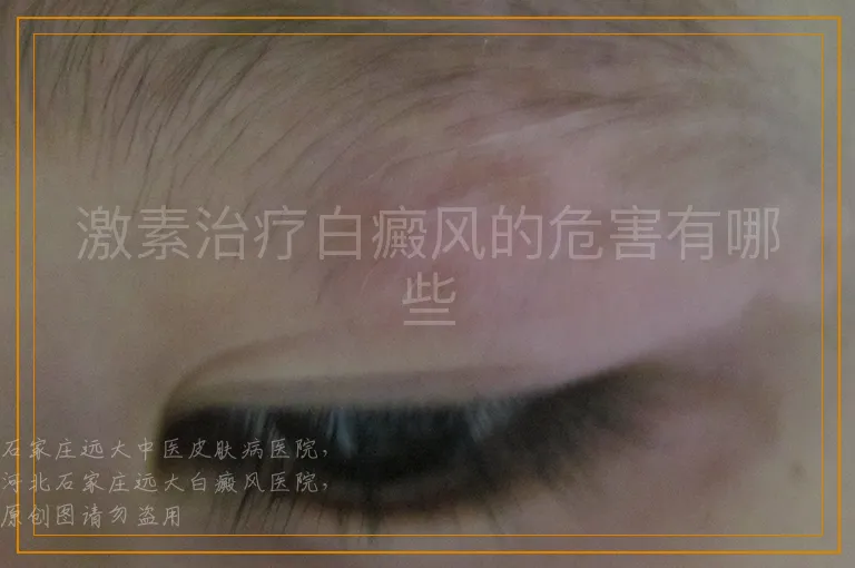 激素治疗白癜风的危害有哪些