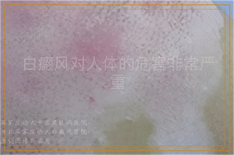 白癜风对人体的危害非常严重