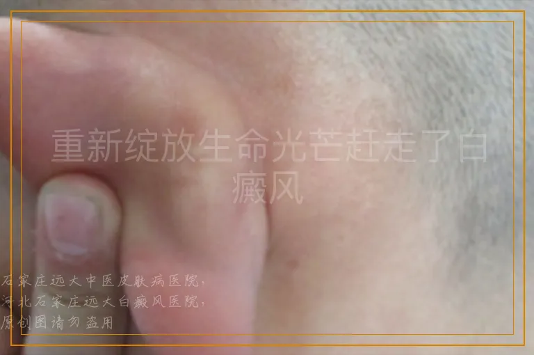 重新绽放生命光芒赶走了白癜风