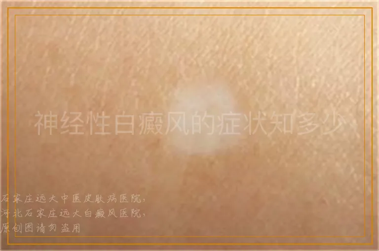 神经性白癜风的症状知多少