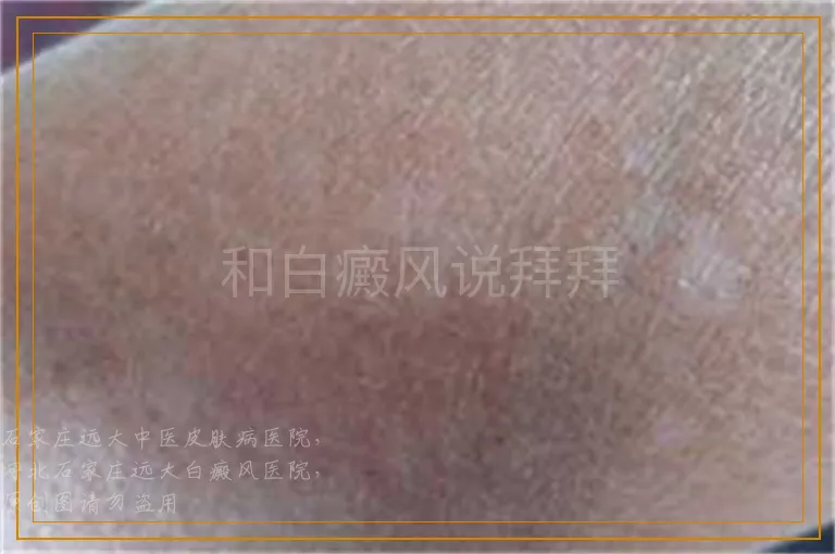 和白癜风说拜拜