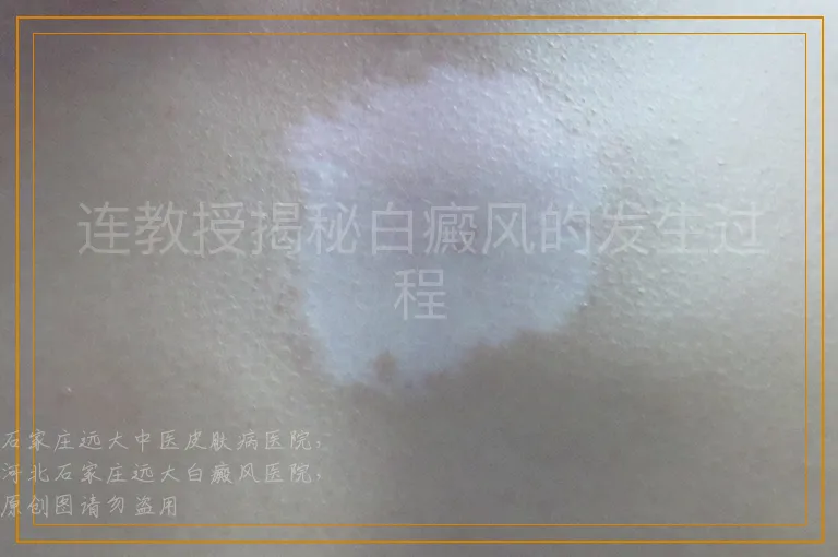 连教授揭秘白癜风的发生过程