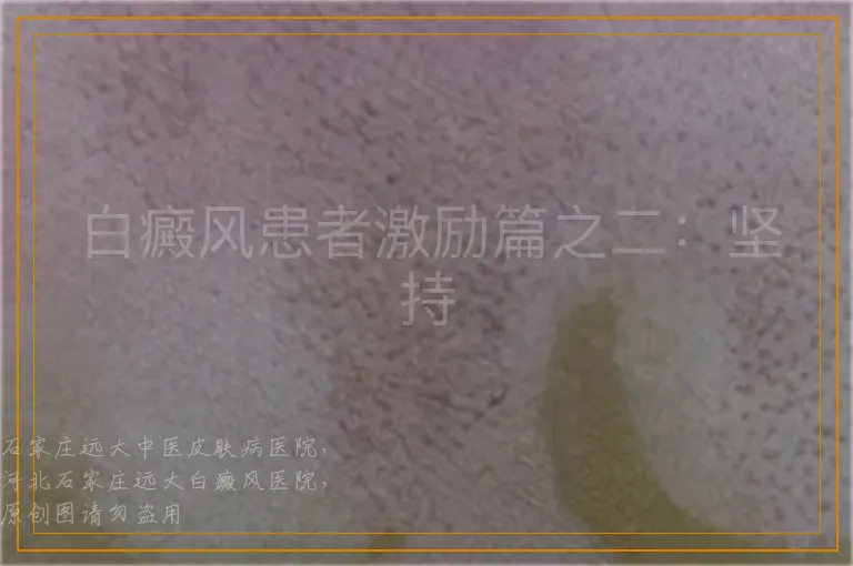 白癜风患者激励篇之二：坚持