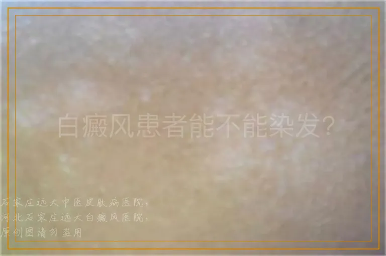 白癜风患者能不能染发?