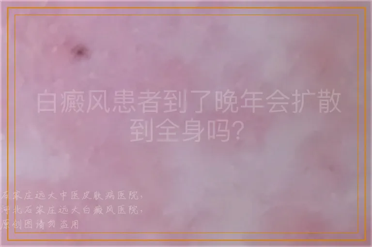白癜风患者到了晚年会扩散到全身吗？