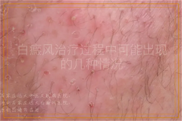 白癜风治疗过程中可能出现的几种情况