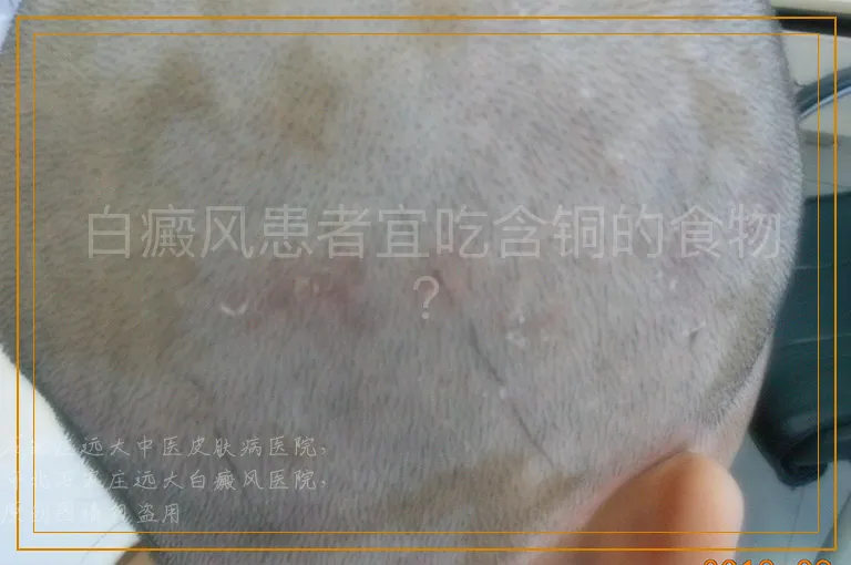 白癜风患者宜吃含铜的食物？
