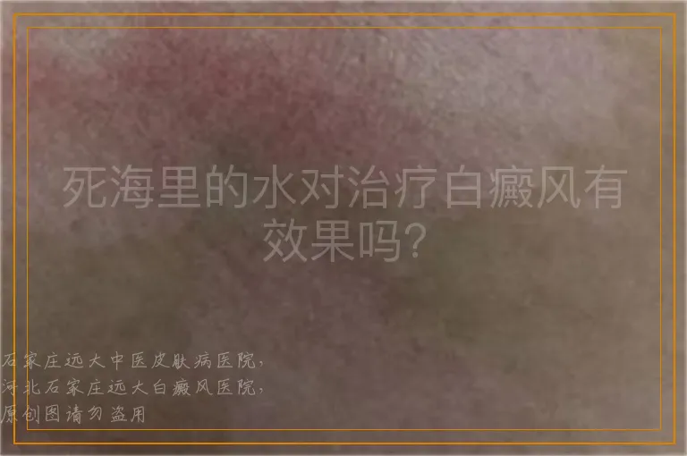 死海里的水对治疗白癜风有效果吗？