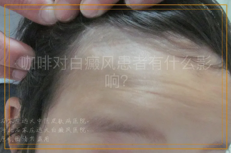 咖啡对白癜风患者有什么影响？