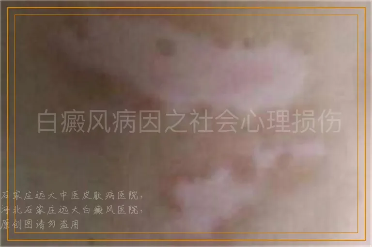 白癜风病因之社会心理损伤