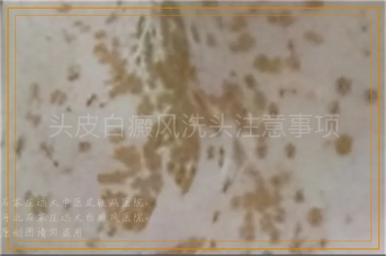 头皮白癜风洗头注意事项