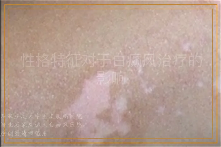 性格特征对于白癫风治疗的影响