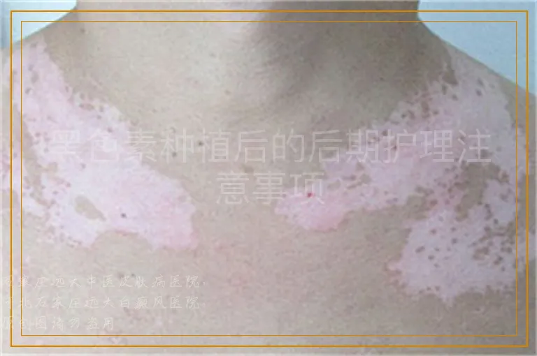 黑色素种植后的后期护理注意事项