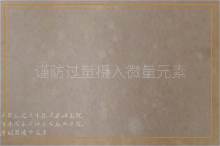 谨防过量摄入微量元素