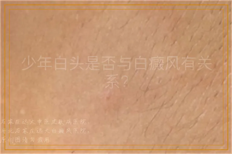 少年白头是否与白癜风有关系?