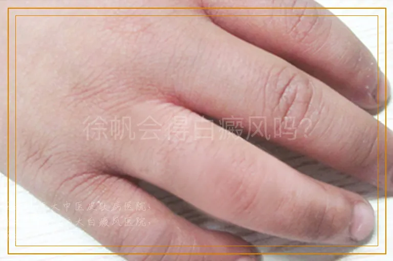 徐帆会得白癜风吗？
