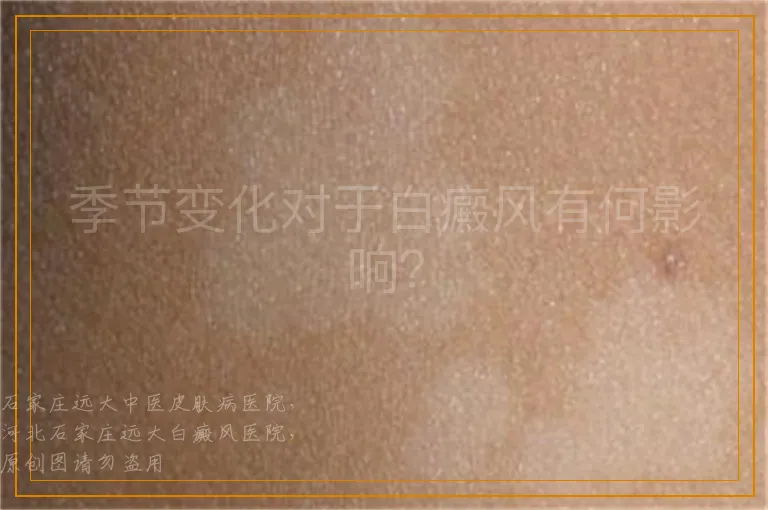 季节变化对于白癜风有何影响？