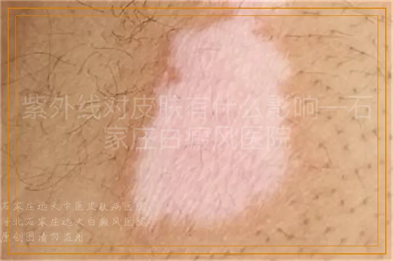 紫外线对皮肤有什么影响—石家庄白癜风医院