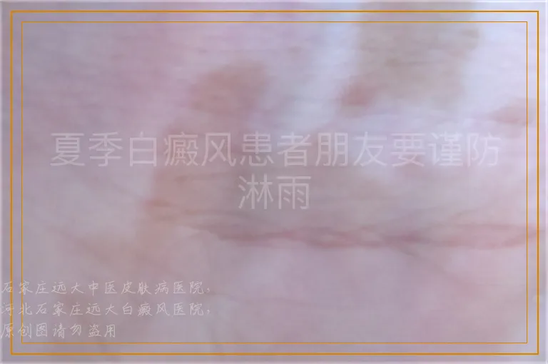 夏季白癜风患者朋友要谨防淋雨