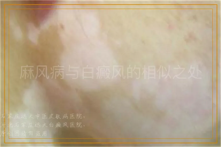麻风病与白癜风的相似之处