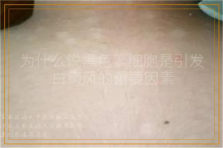 为什么说黑色素细胞是引发白癜风的重要因素