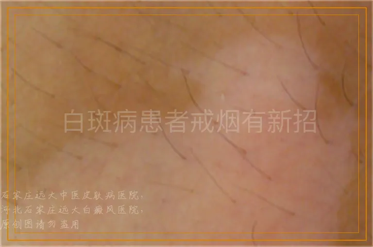 白斑病患者戒烟有新招