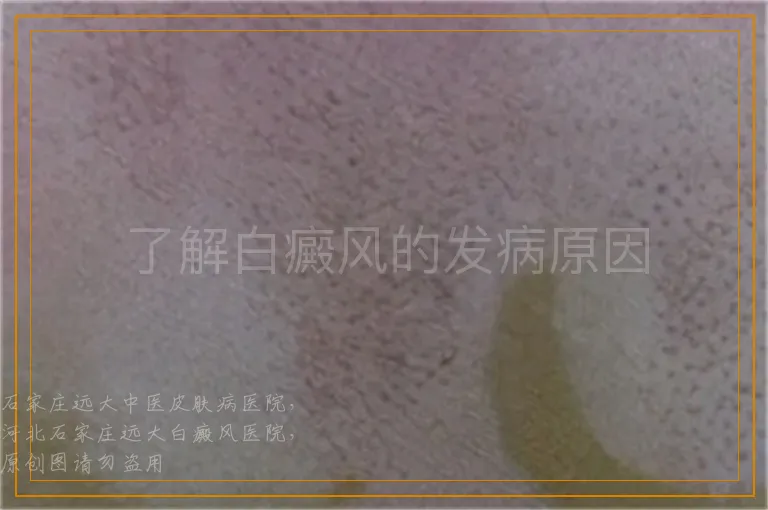 了解白癜风的发病原因
